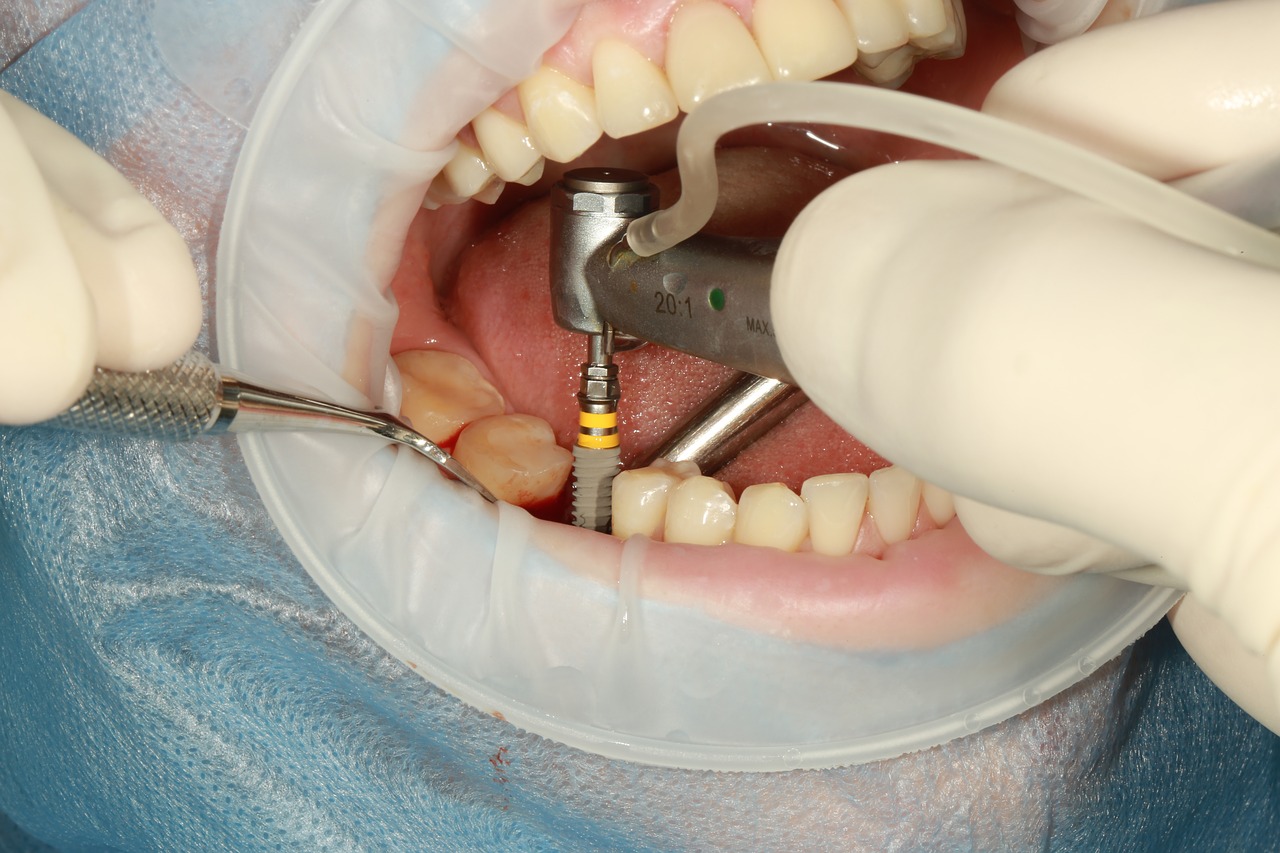Benefits of Dental Implants