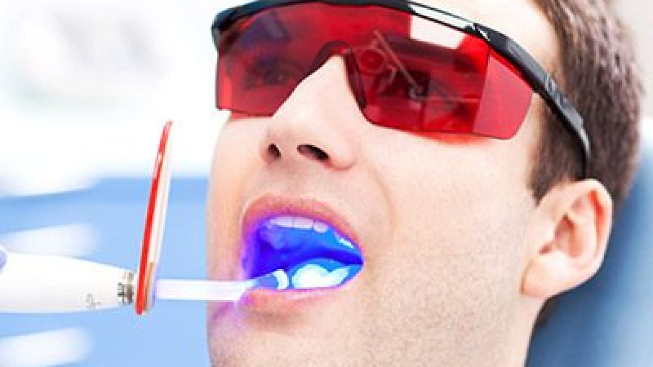 Benefits of Professional Teeth Whitening